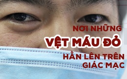 Ở nơi những vệt máu đỏ hằn lên giác mạc