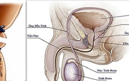 Thắt ống dẫn tinh - Biện pháp tránh thai hiệu quả, ít rủi ro