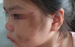 Bé gái ở Bình Dương bầm tím mặt vì cha “lỡ tay khi dạy học": Cần mạnh tay xử lý bạo hành gia đình