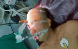 Cưa cây, nam thanh niên bị gỗ văng găm lún sọ vào não