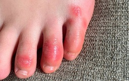 "Ngón chân COVID" và những biểu hiện trên da có thể là dấu hiệu mắc COVID-19