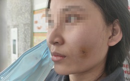 Tiêm filler để tạo khuôn mặt đầy đặn, cô gái 23 tuổi bị nhiễm trùng, áp xe má