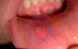 Đây là hiện tượng xuất hiện ở miệng mà 90% người mắc phải có thể là dấu hiệu cảnh báo ung thư nhưng không ai để ý