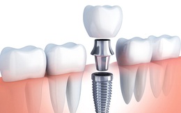 5 yếu tố quyết định tỷ lệ thành công của trồng răng Implant