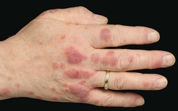 Người đàn ông phát hiện bệnh hiểm nghèo nhờ vết mẩn đỏ trên tay