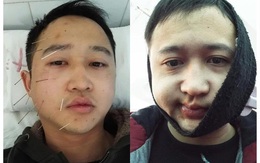 Trời lạnh sâu: Cảnh báo nguy cơ liệt nửa mặt, méo miệng gia tăng, đặc biệt căn bệnh này đang ngày càng trẻ hóa