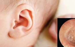 Phòng ngừa và nhận biết những biến chứng nguy hiểm do viêm tai giữa tiết dịch ở trẻ