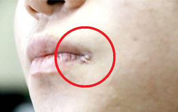 Nữ sinh 15 tuổi bị loét khóe miệng do nhiễm virus HPV dù chưa từng quan hệ, nguyên nhân xuất phát từ thói quen dùng chung 1 đồ vật mà nhiều gia đình mắc phải