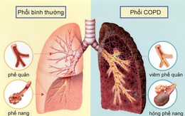 Khoảng 3 triệu người tử vong mỗi năm vì căn bệnh này ở phổi, có 6 dấu hiệu nhận biết khi bệnh mới khởi phát, đáng tiếc nhiều người lại hay bỏ qua