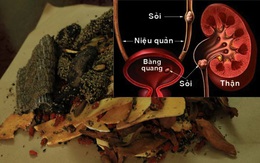 Chuyên gia Đông y giúp bạn điều trị sỏi tiết niệu nhờ bài thuốc bí truyền 150 năm