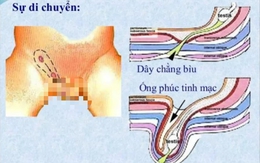 Căn bệnh nguy hiểm cứ 100 trẻ thì có đến 5 trẻ mắc, cha mẹ lại dễ bỏ qua