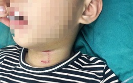 Nghệ An: Bé trai 3 tuổi bị chó cắn rách vùng cổ, thủng khí quản
