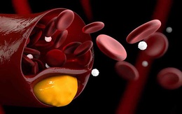 Sản phẩm thảo dược hạ mỡ máu: Xu hướng mới giúp giảm cholesterol, hỗ trợ điều trị mỡ máu cao an toàn, hiệu quả