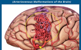 Bé gái 10 tuổi đã bị dị dạng động tĩnh mạch, phải chuyển tới Trung tâm Đột quỵ cấp cứu: Cảnh báo căn bệnh nguy hiểm