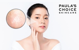 Niacinamide - Chìa khóa giúp thu nhỏ lỗ chân lông