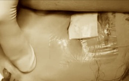 Cô gái 24 tuổi bị nhiễm trùng vùng mặt nghiêm trọng sau 3 năm tiêm filler