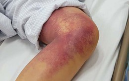 Suy hô hấp, liệt tứ chi sau đêm nằm ngủ đất, nguyên nhân khiến ai cũng giật mình