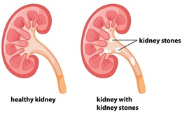 Sỏi thận – liệu có cần phải phẫu thuật hay không?