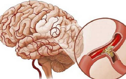 Phòng ngừa tai biến mạch máu não ở người tăng huyết áp