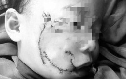 Nghệ An: Bé 3 tuổi bị chó nhà cắn với nhiều thương tích ở vùng mặt