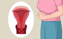 Kiểm soát u xơ tử cung bằng sản phẩm thảo dược - Xu hướng mới được nhiều chị em lựa chọn
