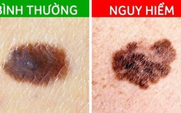 Các dấu hiệu cảnh báo ung thư đang xảy ra trên nốt ruồi trước đây là nốt ruồi lành tính