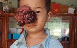 Đau lòng nhìn em bé dân tộc bị khối u đẩy lồi mắt ra ngoài, nguy cơ nhiễm trùng cao không có tiền chữa bệnh