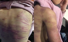 TP.HCM: Thêm một bé gái 9 tuổi nghi bị "chị dâu" bạo hành gây nhiều thương tích