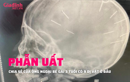 NÓNG: Phẫn nộ nhiều hành động của người tình mẹ bé gái 3 tuổi có 9 dị vật giống đinh trong sọ não