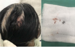 Hà Nội: Nữ công nhân nghi bị "đạn lạc" găm trúng đầu