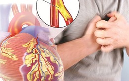 6 loại thực phẩm tốt cho động mạch, hạn chế nguy cơ mắc bệnh tim