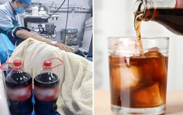 Uống thứ nước giải khát bình dân theo lời khuyên của bác sĩ, bệnh nhân tán được viên sỏi cỡ lớn trong bụng