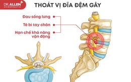 Dr.Allen Chiropractic - chữa thoát vị đĩa đệm bằng phương pháp bảo tồn không phẫu thuật