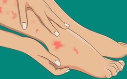 3 đặc điểm ở bàn chân cảnh báo mạch máu bị tắc nghẽn