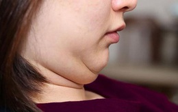 Đoán bệnh qua vị trí mỡ thừa ở từng vùng trên cơ thể của bạn