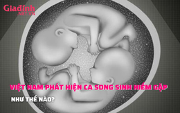 Việt Nam ghi nhận ca song thai hiếm thứ hai trên thế giới như thế nào?