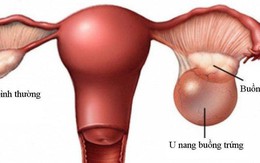 Chuyên gia cảnh báo phụ nữ mang thai không nên chủ quan với u buồng trứng