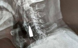 Đạn mắc ở cổ 77 năm không hay biết