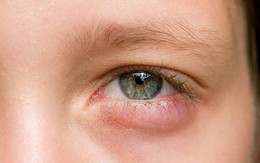 Thiếu quá nhiều vitamin A, cơ thể sẽ xuất hiện những tín hiệu này