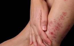 5 vị trí này ngứa thường xuyên cảnh báo bệnh nguy hiểm, chớ chủ quan kẻo hối hận