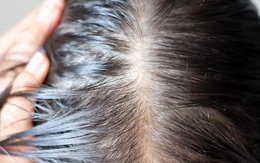 5 lý do không tưởng khiến bạn "hói" dần