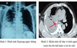 Mỏ gà chui vào phế quản do sặc, nam thực khách được các bác sỹ cứu thành công khi bị nhiễm trùng nặng