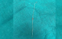 Ký sinh trùng dài 12cm chui vào má người phụ nữ sau khi bị muỗi đốt