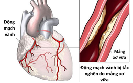 Các dấu hiệu nhận biết bệnh nhồi máu cơ tim cấp