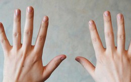 7 dấu hiệu ở tay cảnh báo sức khoẻ có vấn đề
