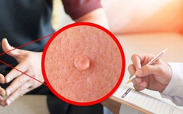 Bệnh tình dục gia tăng ở nhóm người trẻ, có người điều trị sùi mào gà 15 lần không khỏi