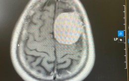 Phát hiện khối u lớn trong não sau cơn đau đầu dữ dội