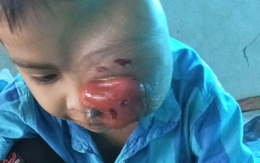 MS 810: Xót xa hình ảnh cậu bé 6 tuổi biến dạng khuôn mặt, một bên mắt đã mù vĩnh viễn vì khối u lớn