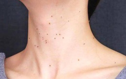 Cô gái 24 tuổi bỗng nhiễm virus HPV sau khi bị ngứa cổ dù chưa từng có bạn tình, nguồn gây bệnh hóa ra đến từ một hoạt động thể dục