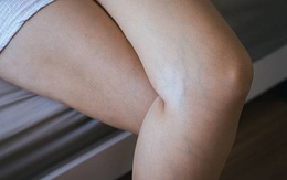 Gân xanh bỗng xuất hiện ở 3 vùng trên cơ thể cho thấy sức khỏe của bạn đang có vấn đề, đừng chủ quan bỏ qua